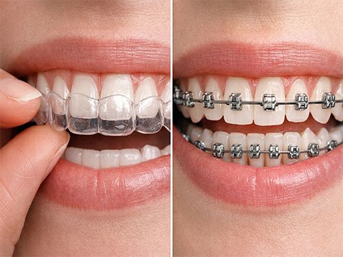 Clear Aligners / Braces