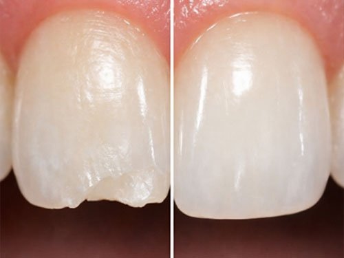 Cosmetic Fillings