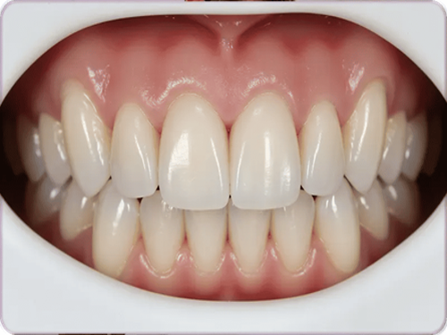 Smile Designing