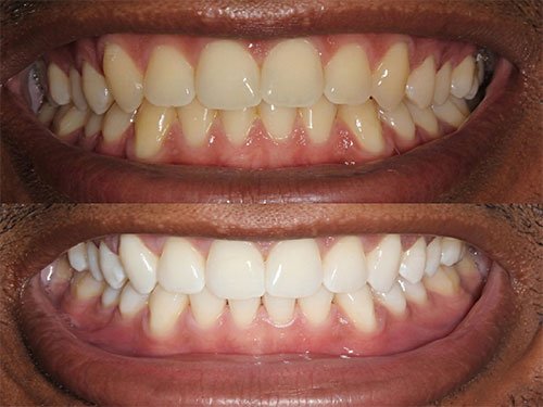 Complete Partial Dentures