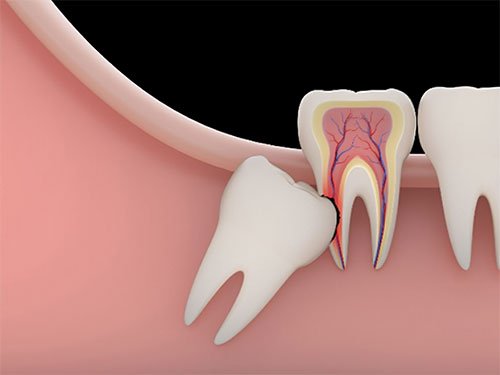 Wisdom Tooth