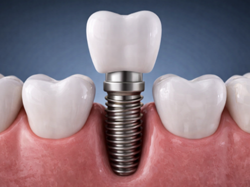 Dental Implants
